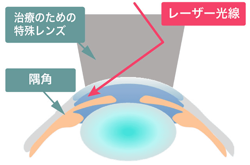 隅角にレーザーをあてる治療